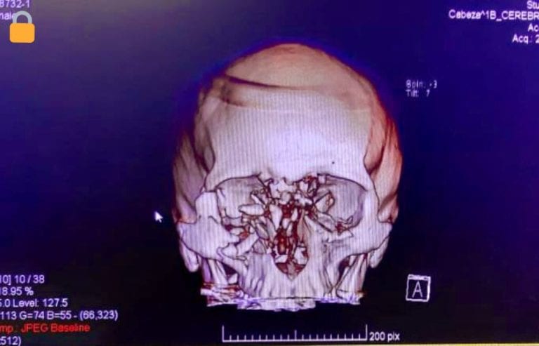Radiografía del cráneo de Fabiola Campillai luego del disparo | Foto: José Miguel Araya, @josemiguelaraya